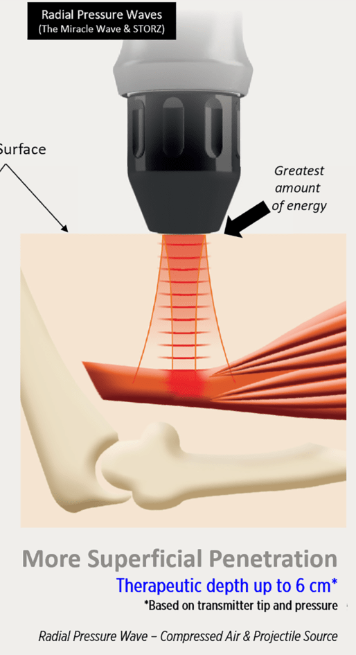Shockwaves-vs-Radial-Pressure-Waves-penetration-